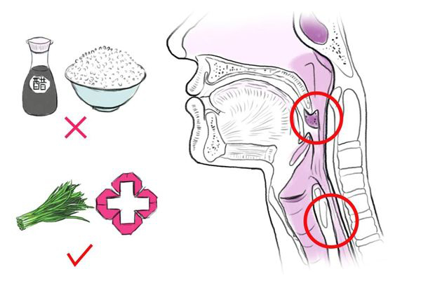 S型鱼刺两头插入食道，惊险！异物卡喉咙应这样处理