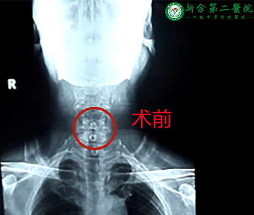 省内前沿技术:颈椎前路ACDF术 巧用“钥匙孔”解除颈椎顽疾