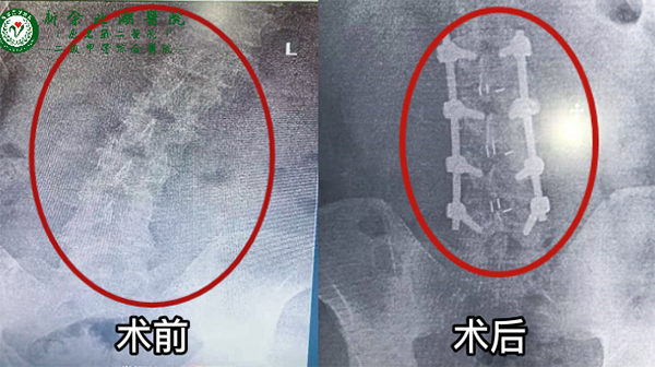 腰椎后路P-T LIF术：肥胖小伙行走困难 术后病情有效缓解