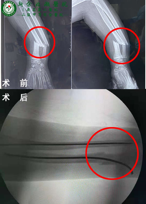 克氏复位针：弹性钉微创疗法，骨折男孩术后两天康复出院