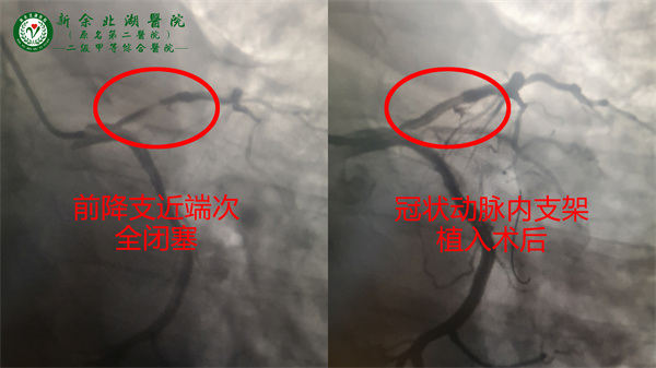 心肌梗死命悬一线： 38分钟紧急双绕行 —— 成功植入支架