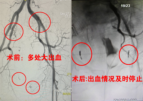 老太被撞骨盆骨折伴失血性休克：介入栓塞术及时止血救命