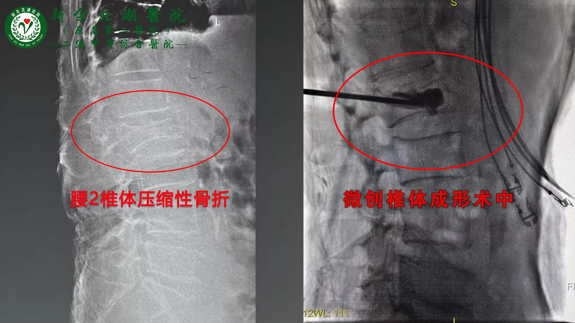 百岁老人重站立，椎体成形助一臂——我院微创脊柱再赢赞誉