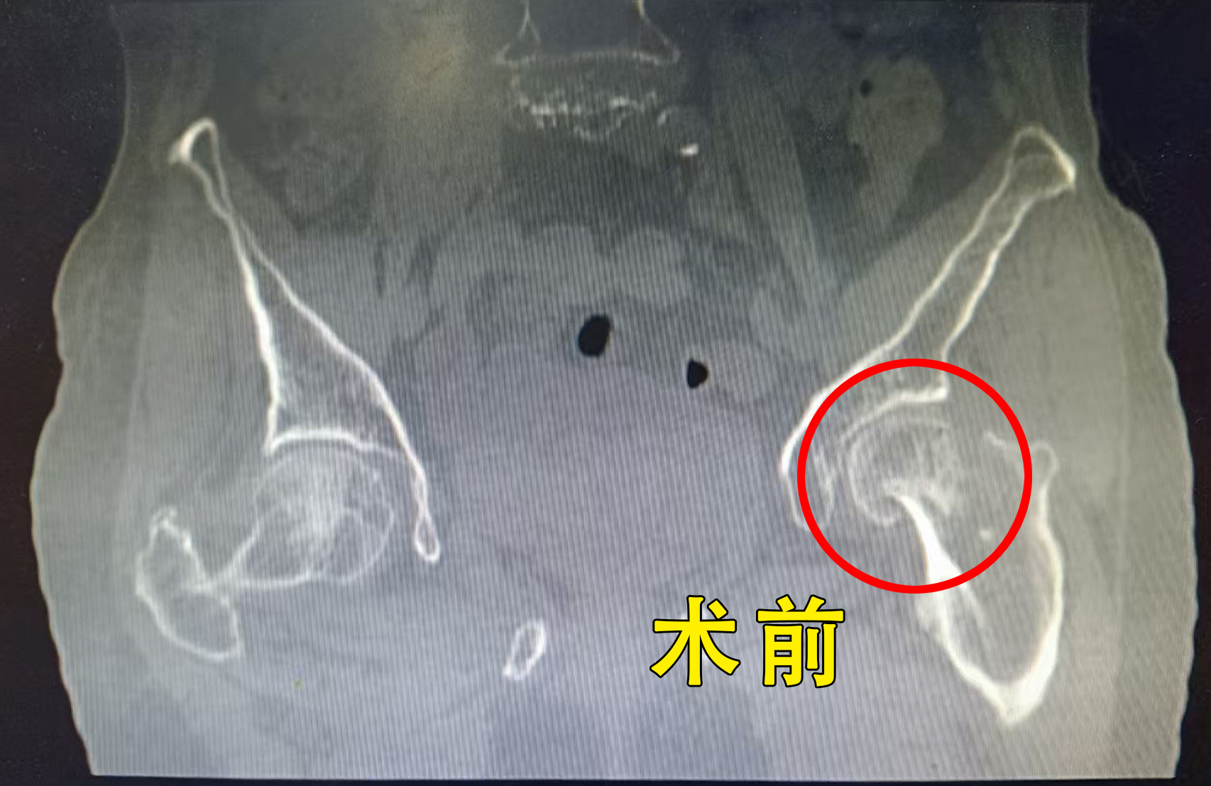 多科联动，我院成功为89岁高龄患者完成髋部骨折手术