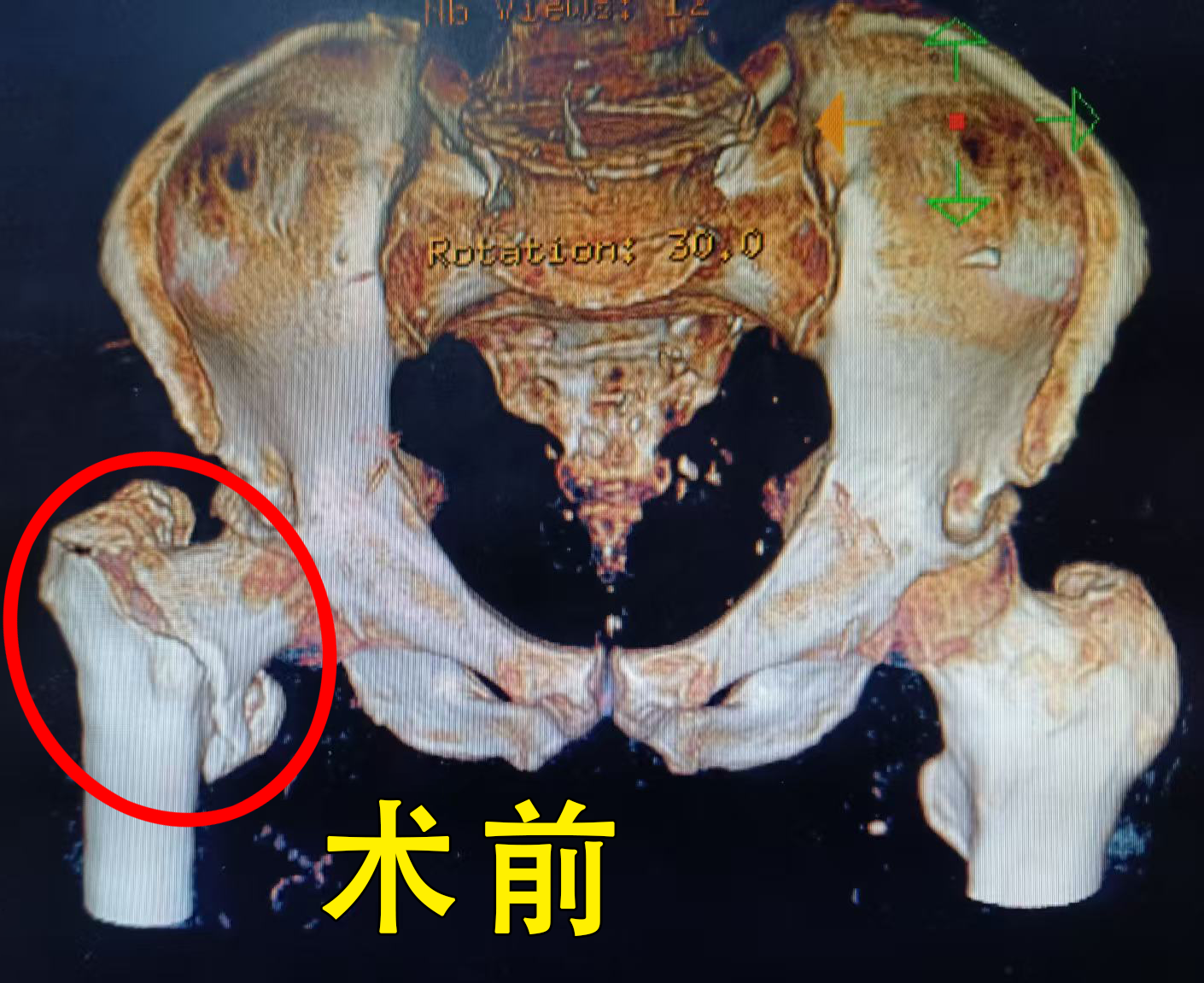 91岁老人髋部粉碎性骨折，我院多科协作成功实施手术