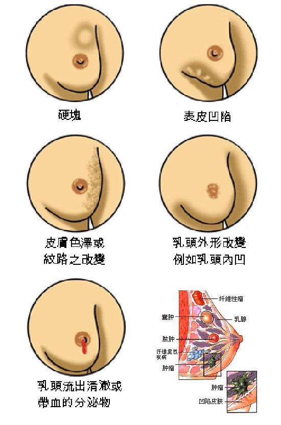 你对乳腺癌了解有多少？一个人人都应知道的乳腺癌科普