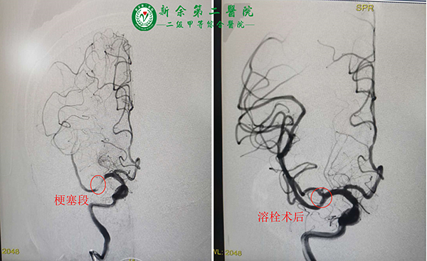 我院连续成功开展多例急性脑梗死静脉溶栓及动脉取栓