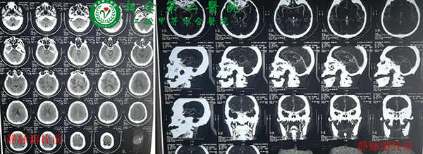 我院连续成功开展多例急性脑梗死静脉溶栓及动脉取栓