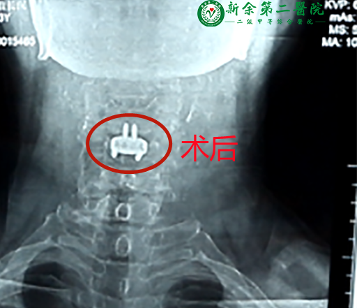 省内前沿技术:颈椎前路ACDF术 巧用“钥匙孔”解除颈椎顽疾