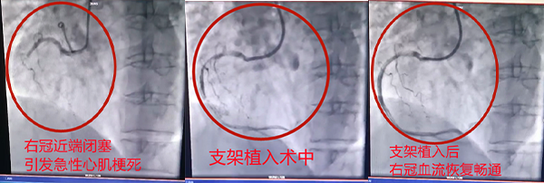 为心梗老人成功实施冠状动脉支架植入术—医生及时准确诊断