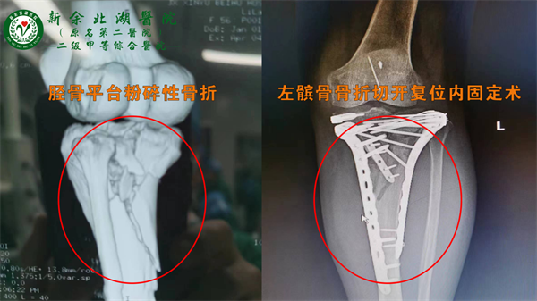 雨天路滑胫骨碎，小切口完成多救助—— 胫髌骨切开复位术