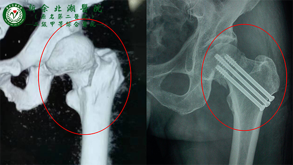 飞车狂飙凶险找，粉身碎骨极限救——关节镜下行骨+左骨股颈骨折+左髌骨粉碎性骨折切开复位内固定术微创救助