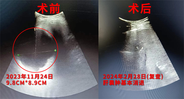 【微创】“1毫米细针”解决“10厘米肝囊肿”——肝脏囊肿介入穿刺引流+硬化术