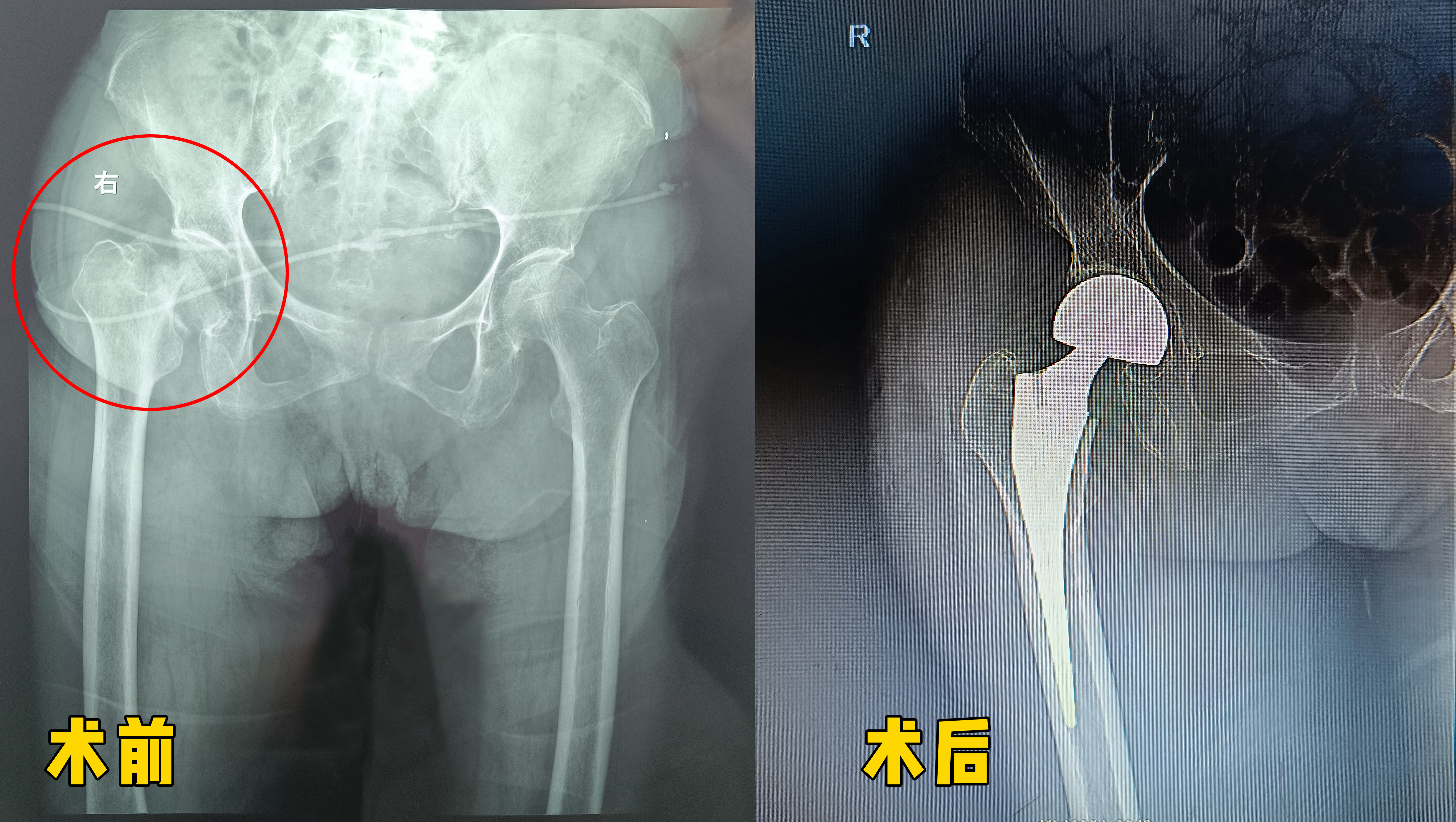 守护银龄步履：为92岁高龄患者实施人工双动头髋关节置换术